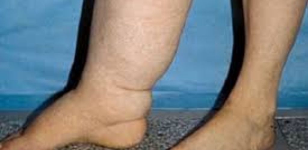 सीएमओ ने फाइलेरिया रोधी दवा खाने की करी अपील